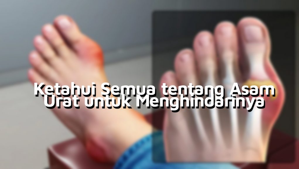 Semua tentang Asam Urat Semua tentang Asam Urat